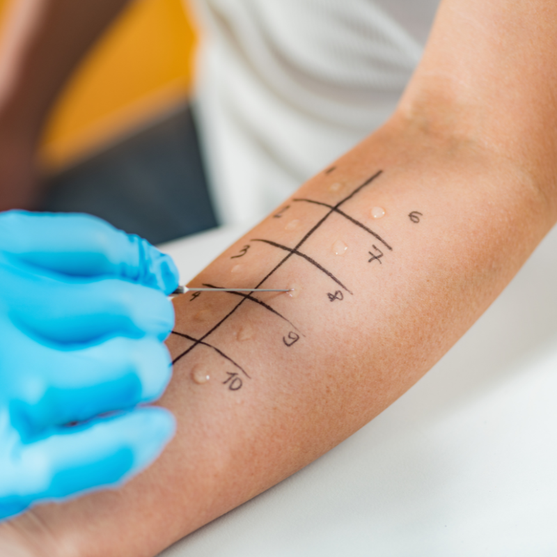 ALLERGY SKIN TESTS