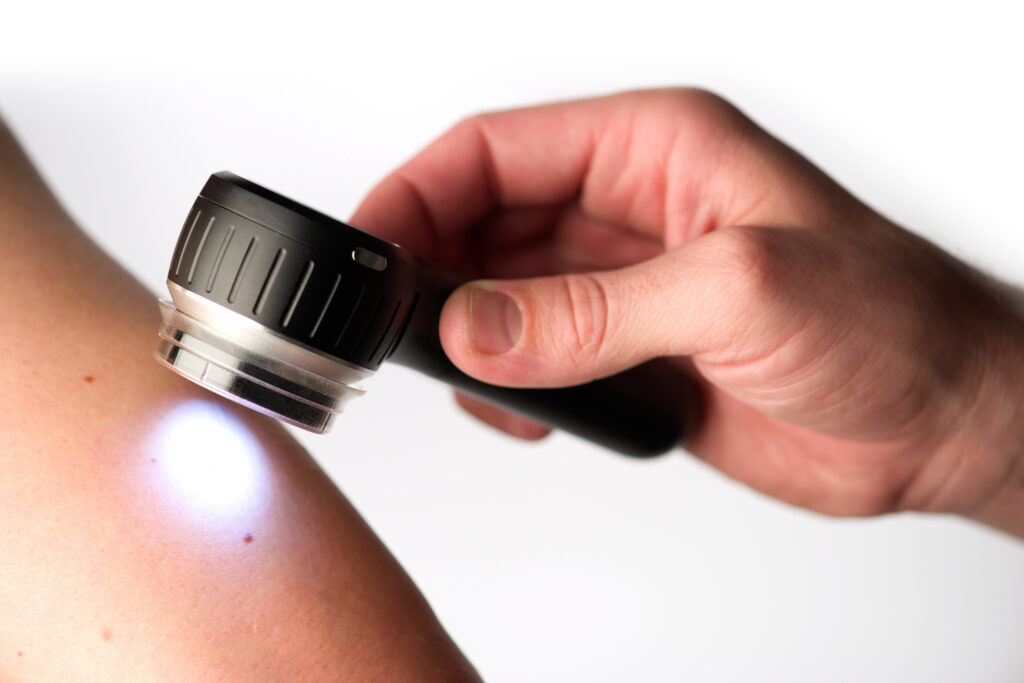 Main tenant un dermatoscope