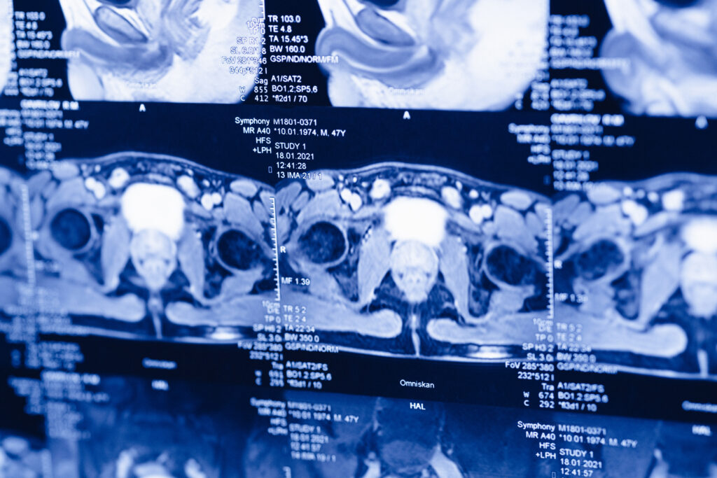 IRM de prostate à l'écran